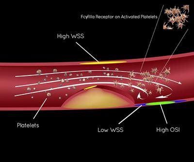 Endothelial Shear Stress and Platelet FcγRIIa Expression in Intracranial Atherosclerotic Disease